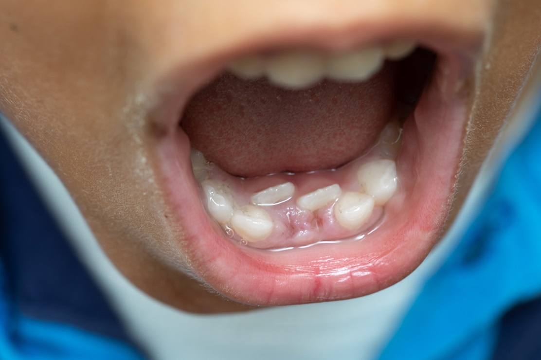Iperdontia e salute orale nei bambini