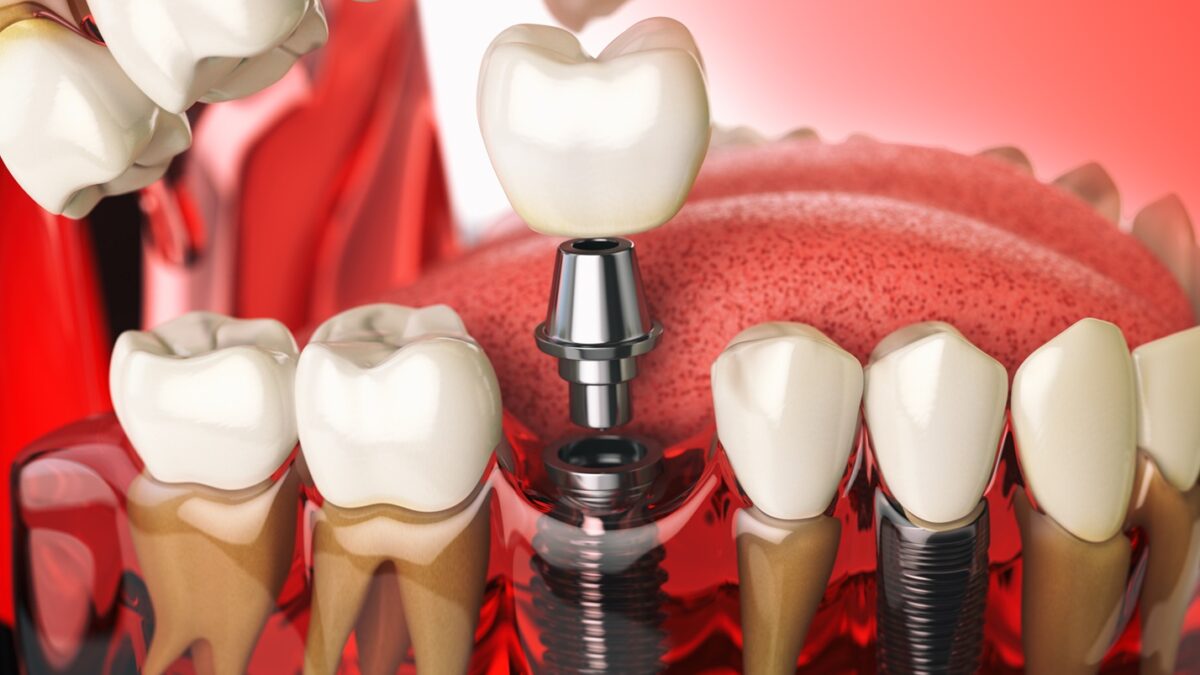 Capire i procedimenti degli impianti dentali la tua guida passo-passo