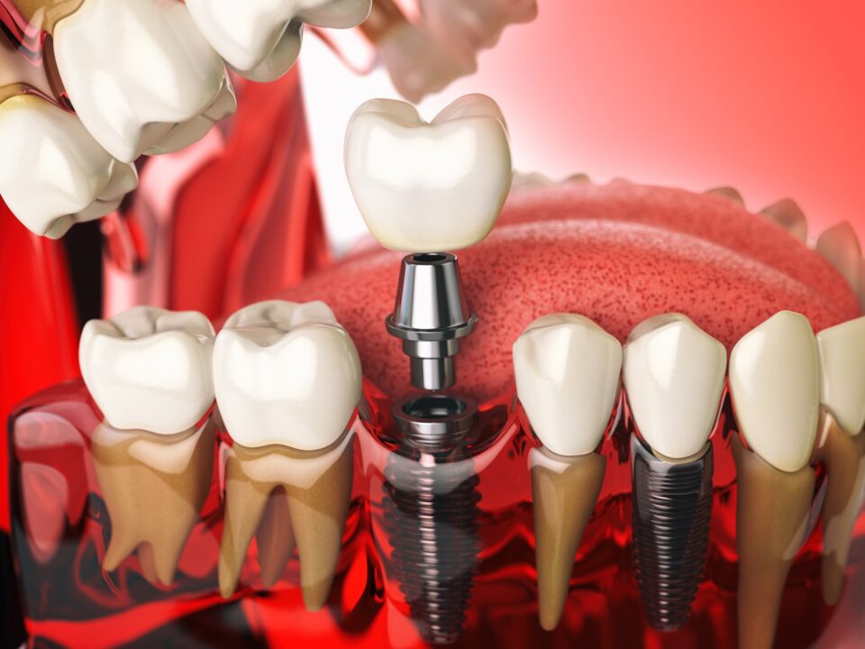 Capire i procedimenti degli impianti dentali la tua guida passo-passo