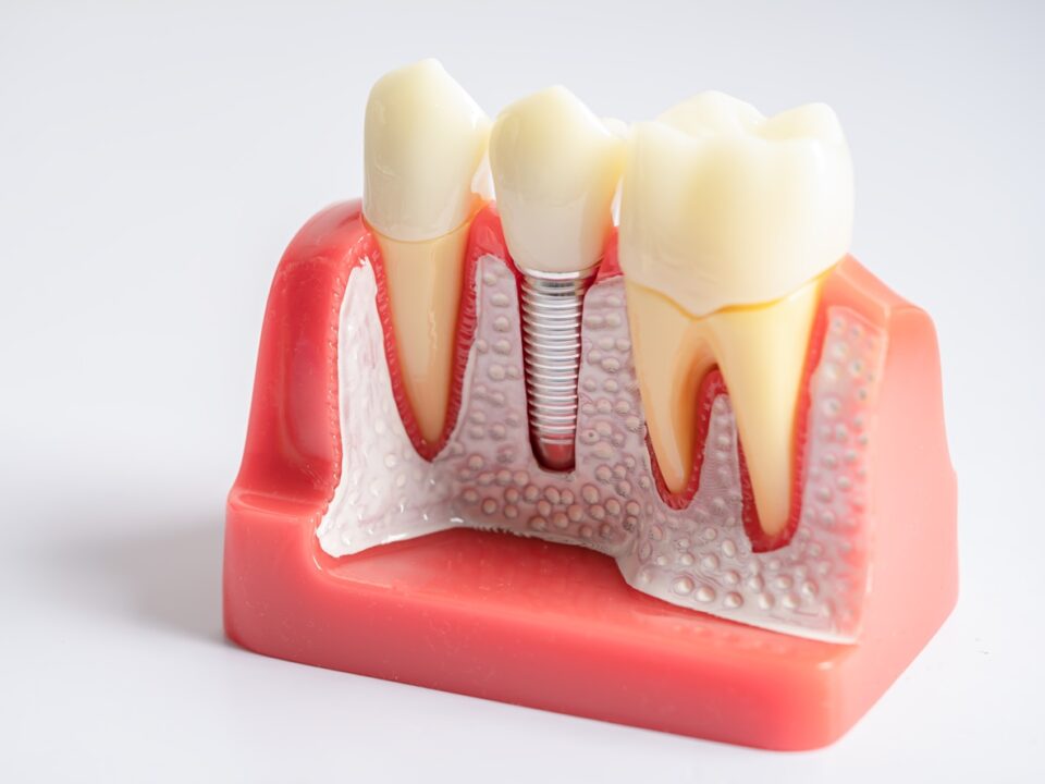 Fallimento dell'Impianto Dentale Cause e Prevenzione